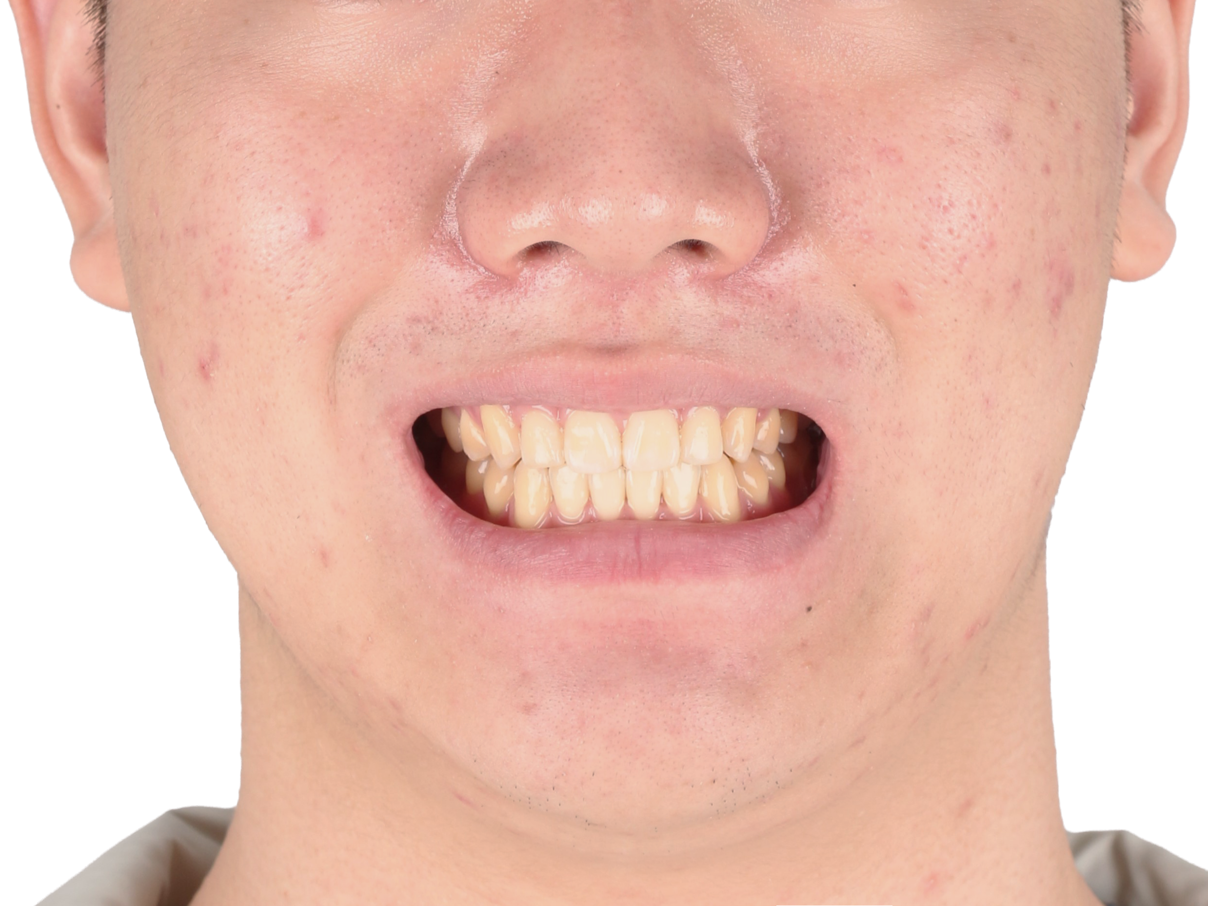 중심선 · 비대칭 사례 01 얼굴 정면 치료 후