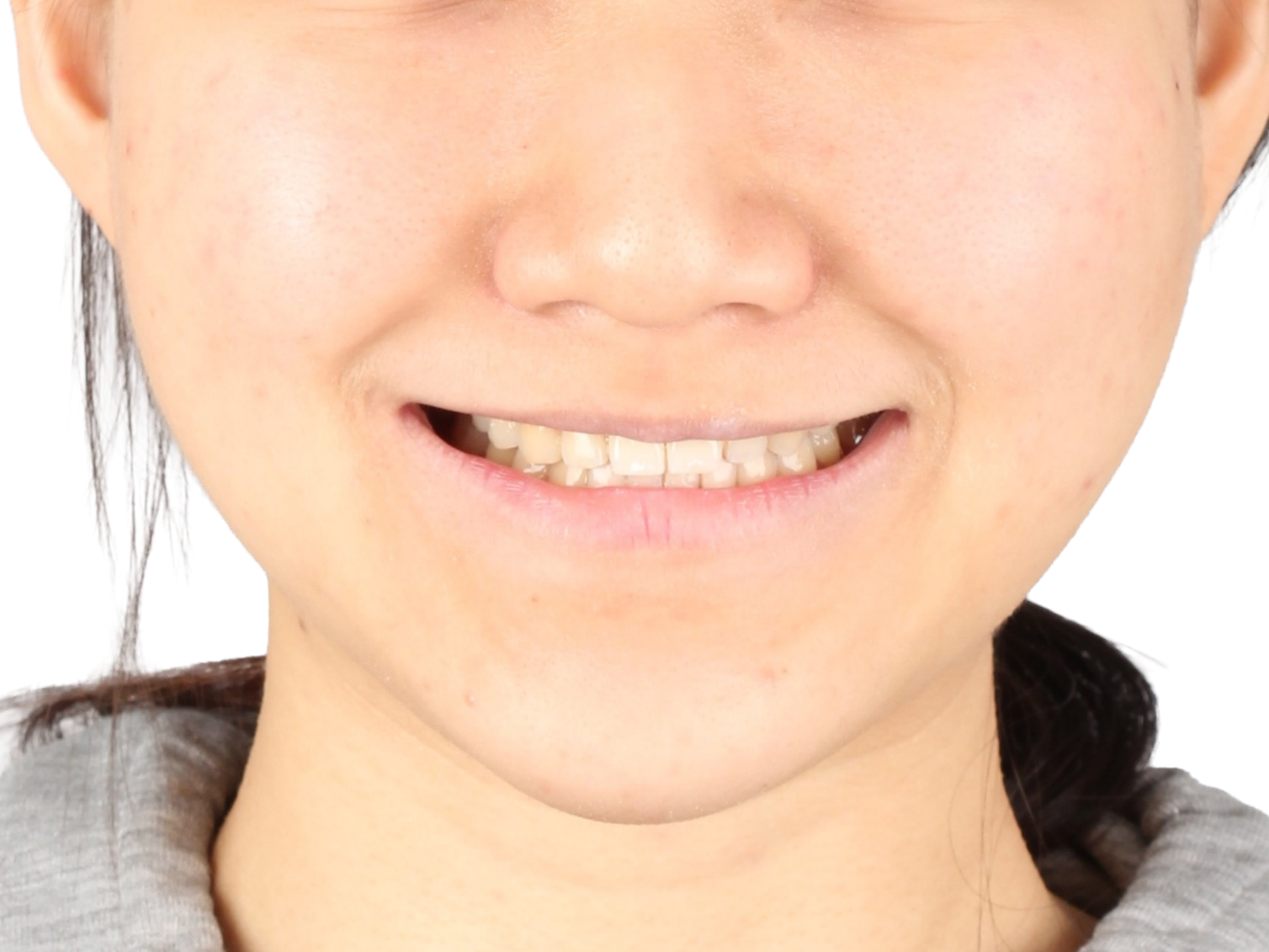 중심선 · 비대칭 사례 02 얼굴 정면 치료 후