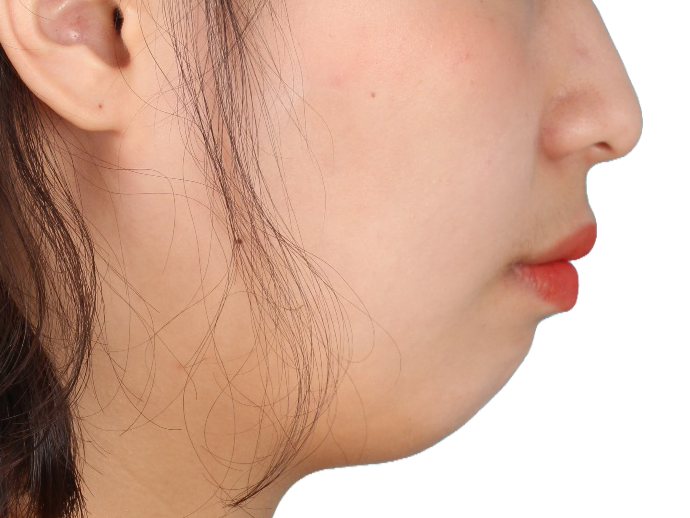 무턱 교정 사례 02 얼굴 옆모습 치료 전